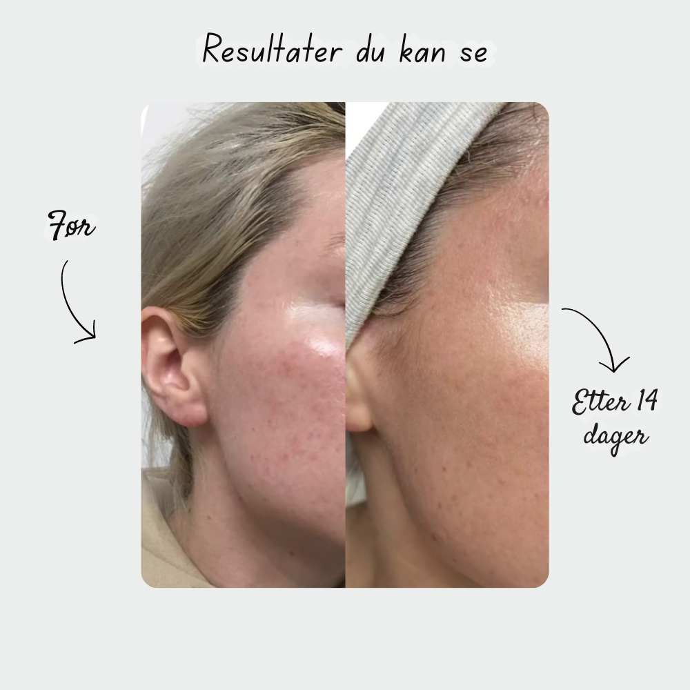 SkinPro 2.0 – 4-i-1 hudpleiestav med rødt lysterapi (+Gratis serum)