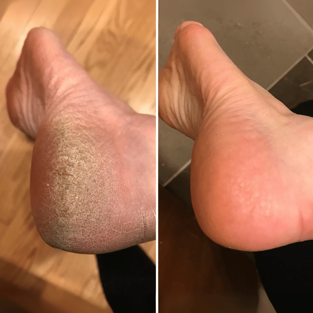 Elektrisk Fothøvel - AVABeauty.no