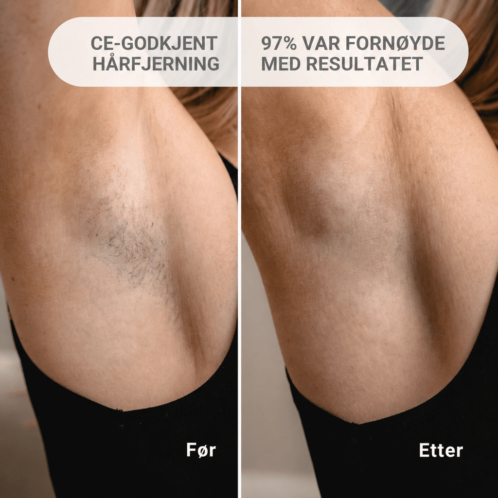 IPL - Permanent hårfjerner - AVABeauty.no