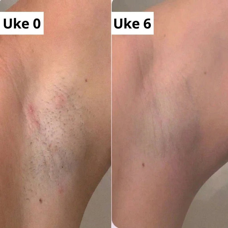 Unngå irritasjon på sensitiv hud