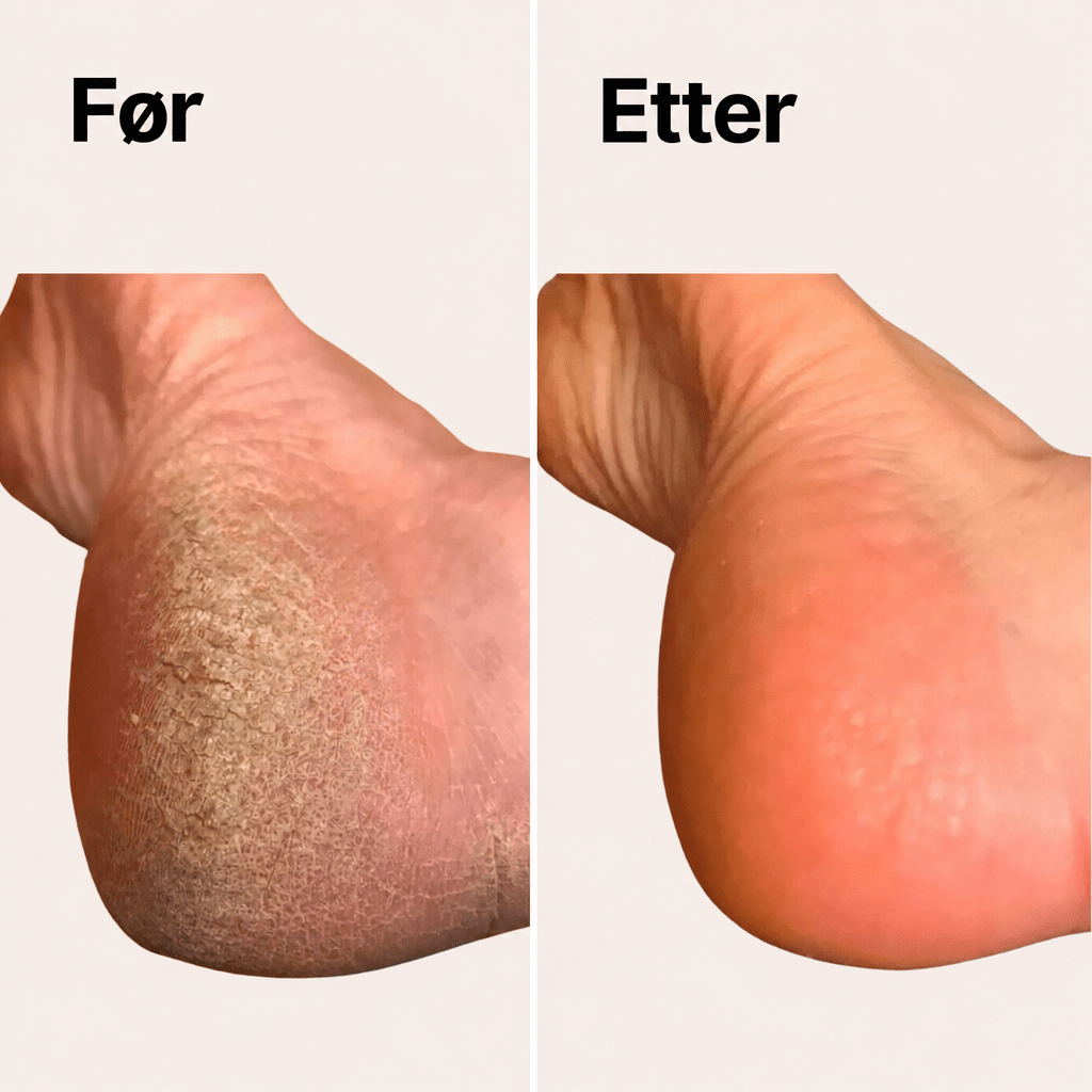 SoleCare elektrisk callusfjerner for hard hud - AVABeauty.no